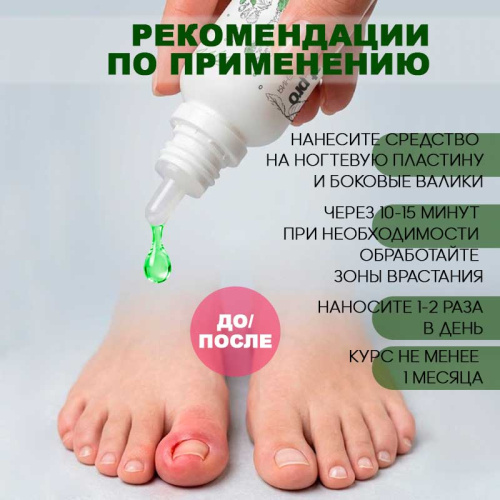 Средство против вросшего ногтя 18 мл. KERATOLITIK18 фото 2
